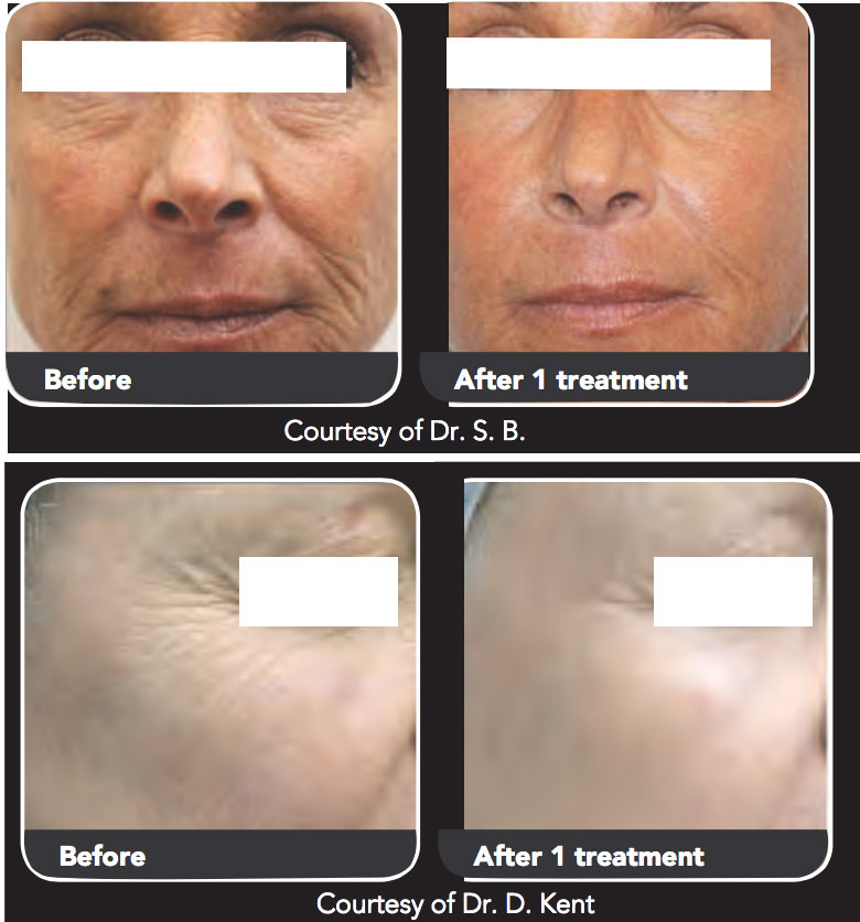 CoolPeel-Tetra-CO2-Skin-Rejuvenation-BeforeAfter2