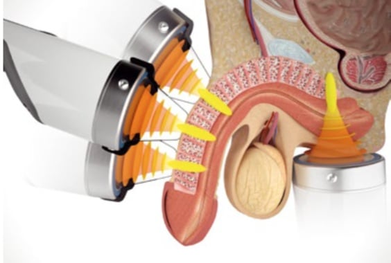 Erectile Dysfunction Shockwave Therapy Erectile Dysfunction Shockwave Therapy in Nalpes