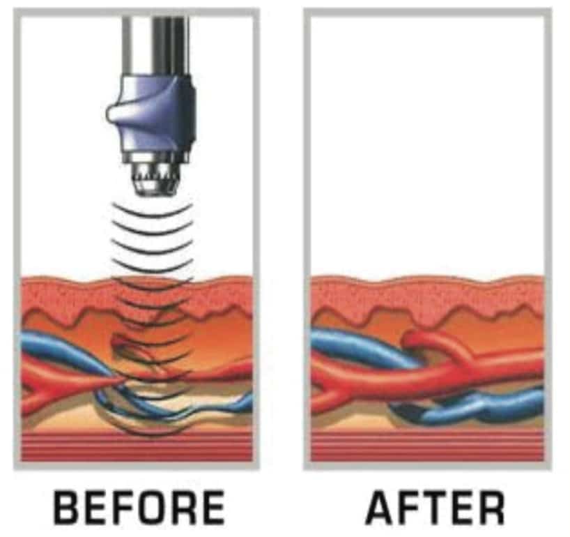 Erectile Dysfunction Acoustic Wave Therapy Before After