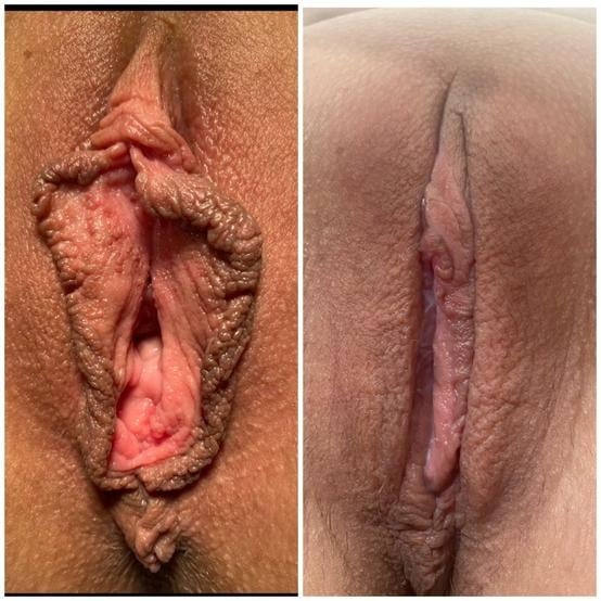 Labiaplasty for women in Fort Myers and Naples Before and After