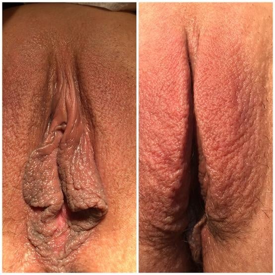 Labiaplasty for women in Fort Myers and Naples Before and After
