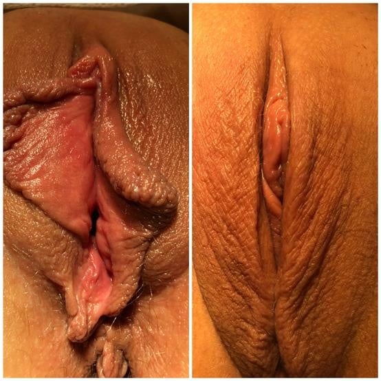 Labiaplasty for women in Fort Myers and Naples Before and After