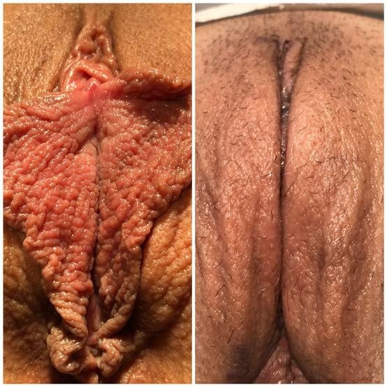 Labiaplasty for women in Fort Myers and Naples Before and After