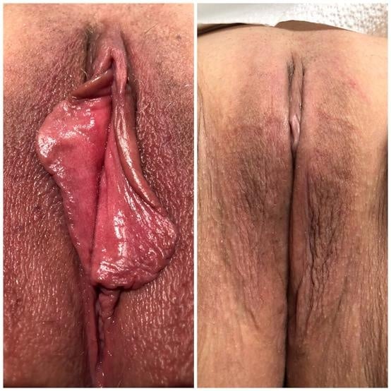 Labiaplasty for women in Fort Myers and Naples Before and After