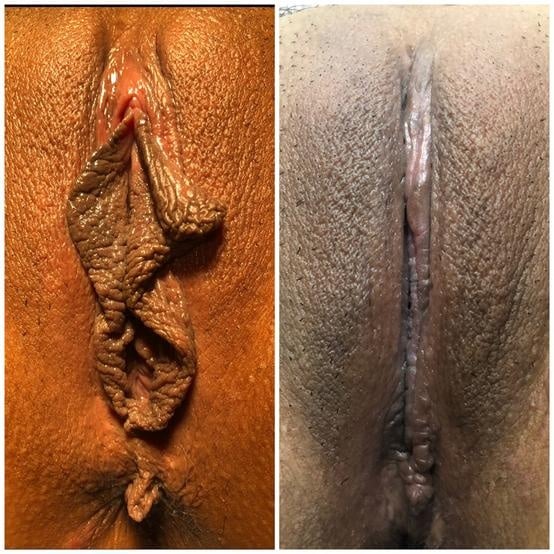 Labiaplasty for women in Fort Myers and Naples Before and After
