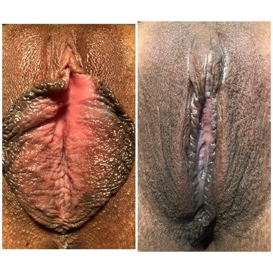 Labiaplasty for women in Fort Myers and Naples Before and After