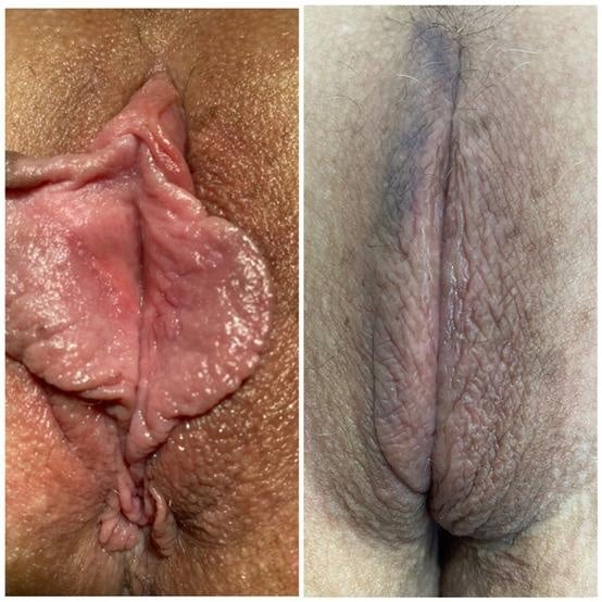 Labiaplasty for women in Fort Myers and Naples Before and After