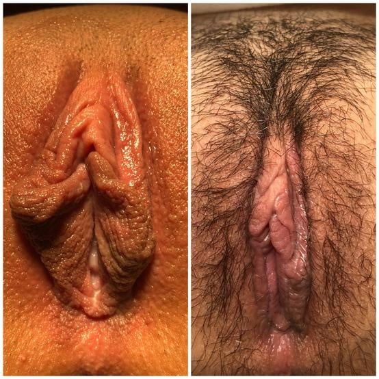 Labiaplasty for women in Fort Myers and Naples Before and After