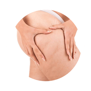 Have your cellulite treated Contemporary Health Center Cellulaze Treatments