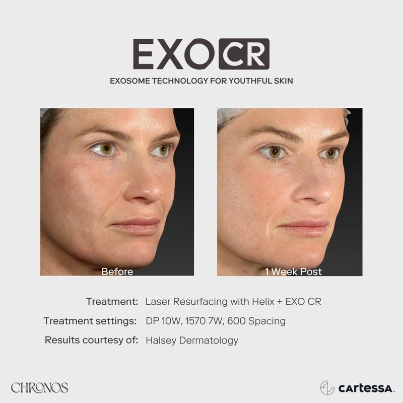 chronos exosome rejuvenation therapy before and after results in fort myers and naples
