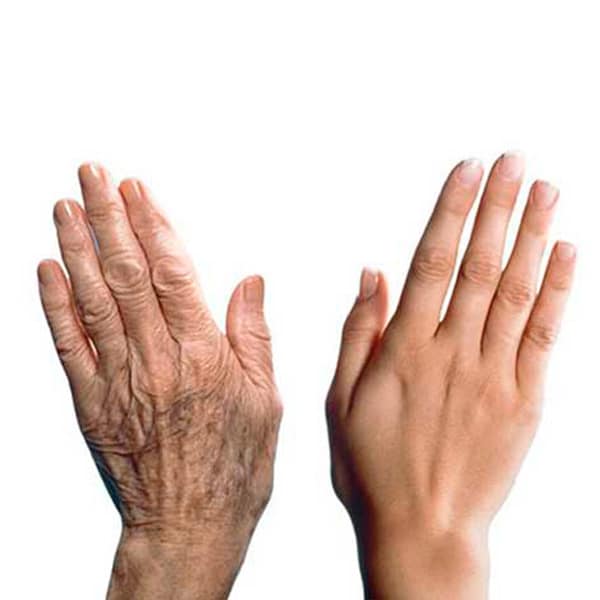 Hand Rejuvenation Treatments Hand Rejuvenation Treatments in Fort Myers