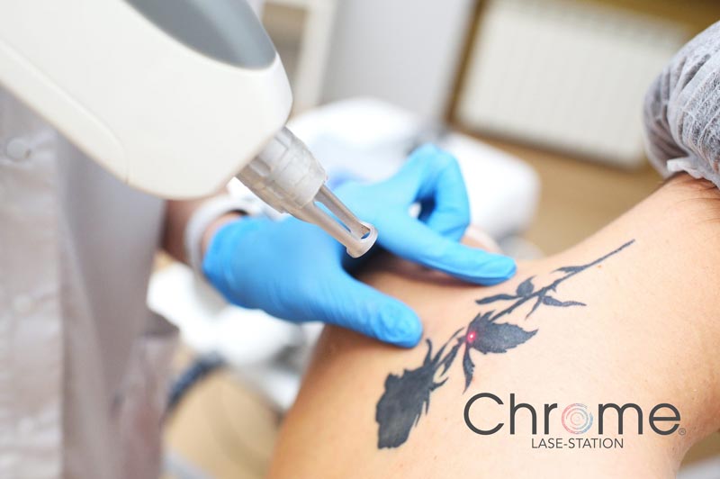 Laser Tattoo Removal Fort Myers