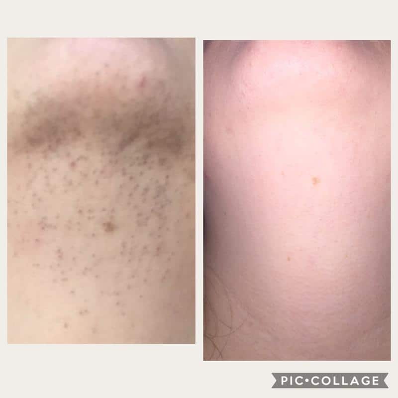 motus ax laser hair removal before and after resutls on a woman
