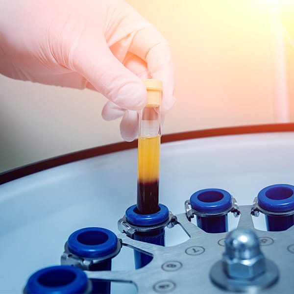 PRP platelet rich plasma treatment in Fort Myers and aples