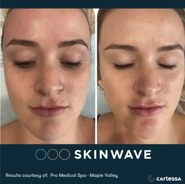 skinwave-before-after-1 Skinwave hydrofacial before and after results in fort myers and naples, fl