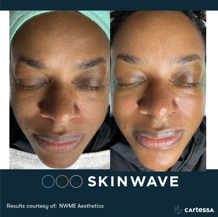 skinwave-before-after-2 Skinwave hydrofacial before and after results in naples and fort myers, fl