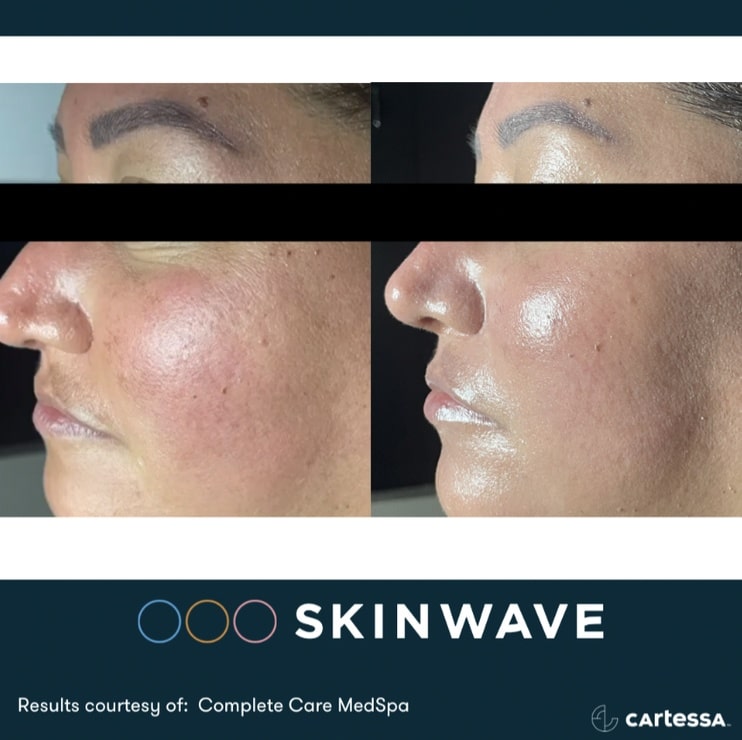 Skinwave hydrofacial before and after results in cape coral and bonita springs, fl