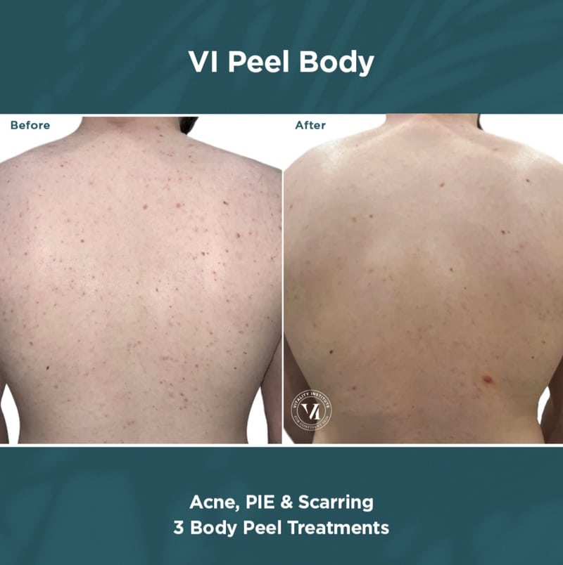 vi peel body chemical peel before and after results on the back of a body