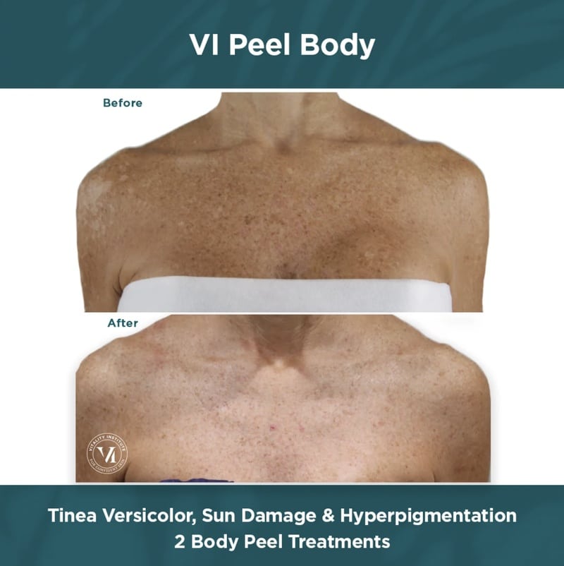 v1-peel-body-chemical-peel-before-after-front vi peel body chemical peel before and after results on the front of a woman's body