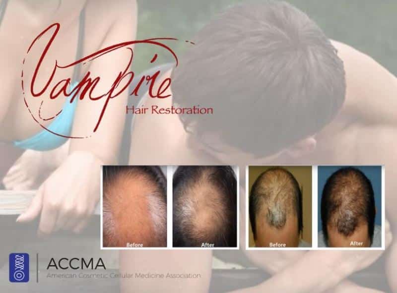 vampire hair restoration in fort myers and naples, fl