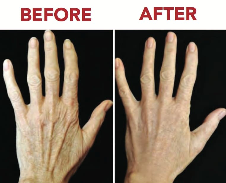 Vampire Hand Lift Vampire Hand Lift before and after results