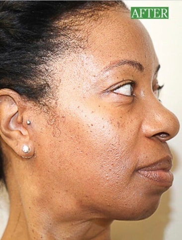 VI Peel for Women Fort Myers After