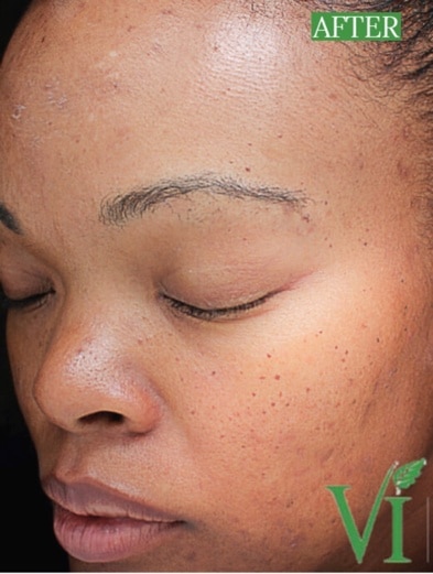 VI Peel for Women Fort Myers After