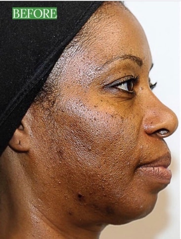 VI Peel for Women Fort Myers Before