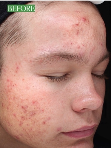 VI Peel for Women Fort Myers After