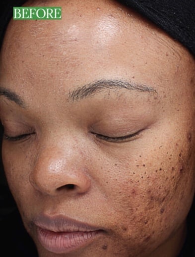 VI Peel for Women Fort Myers Before
