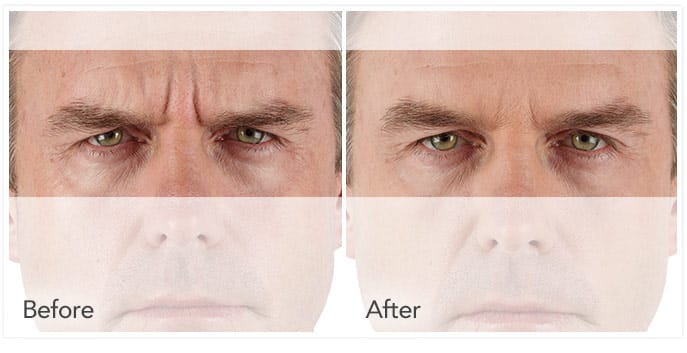 xeomin-before-after-man xeomin before and after man