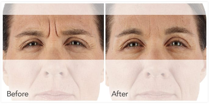 Xeomin treatments in Fort Myers Xeomin treatments in Fort Myers woman before and after