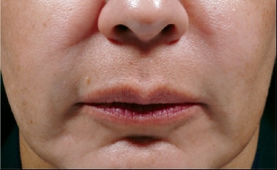 bellafill after results for female