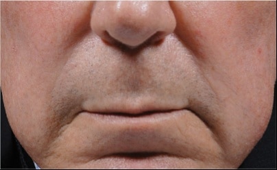 bellafill after results for male