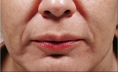 bellafill before results for female