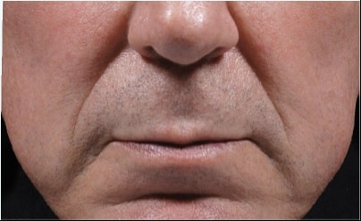 bellafill before results for male